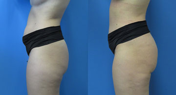 Abdominoplasty & Liposuction width='360