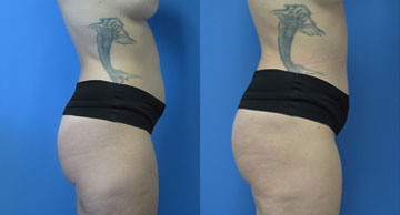 Abdominoplasty & Liposuction width='360