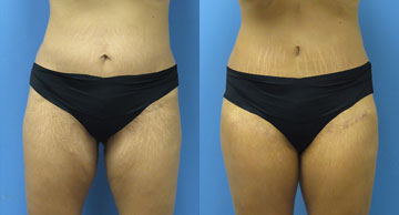 Abdominoplasty + Liposuction