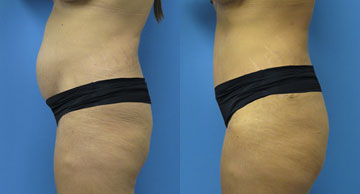 Abdominoplasty + Liposuction width='360