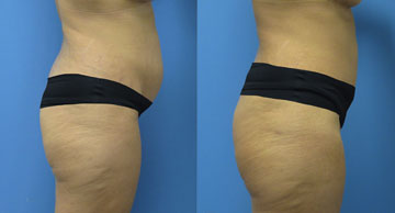 Abdominoplasty + Liposuction width='360