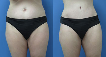 Abdominoplasty + Liposuction