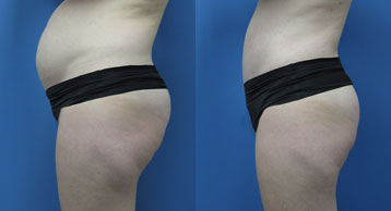 Abdominoplasty + Liposuction width='358