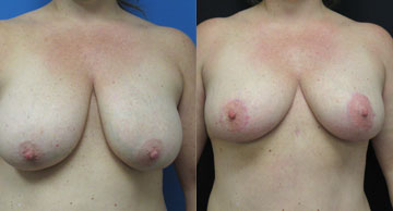 Dr. Christine Rodgers Denver Plastic Surgery before and after photos of Breast Reduction width='360