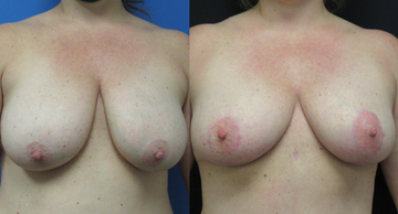 before and after photos of female breasts before and after breast augmentation Dr. Christine Rodgers Denver Plastic Surgery case 003