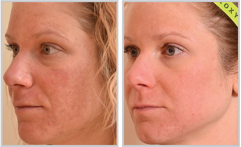Halo Fractional Laser