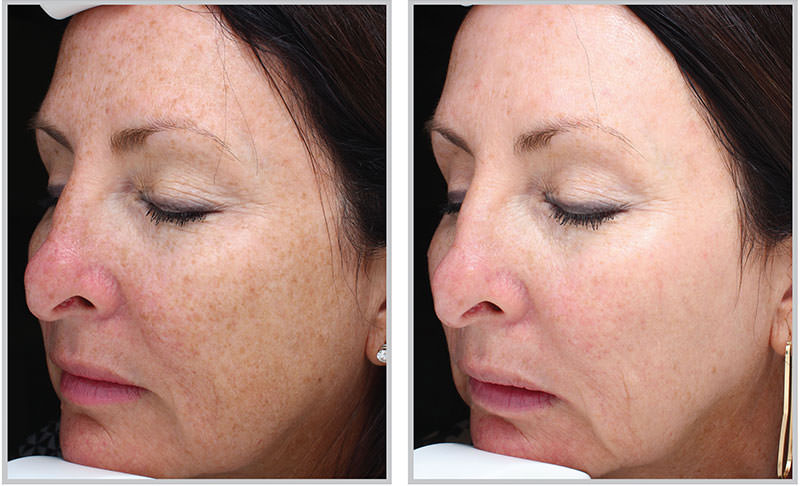 Halo Fractional Laser